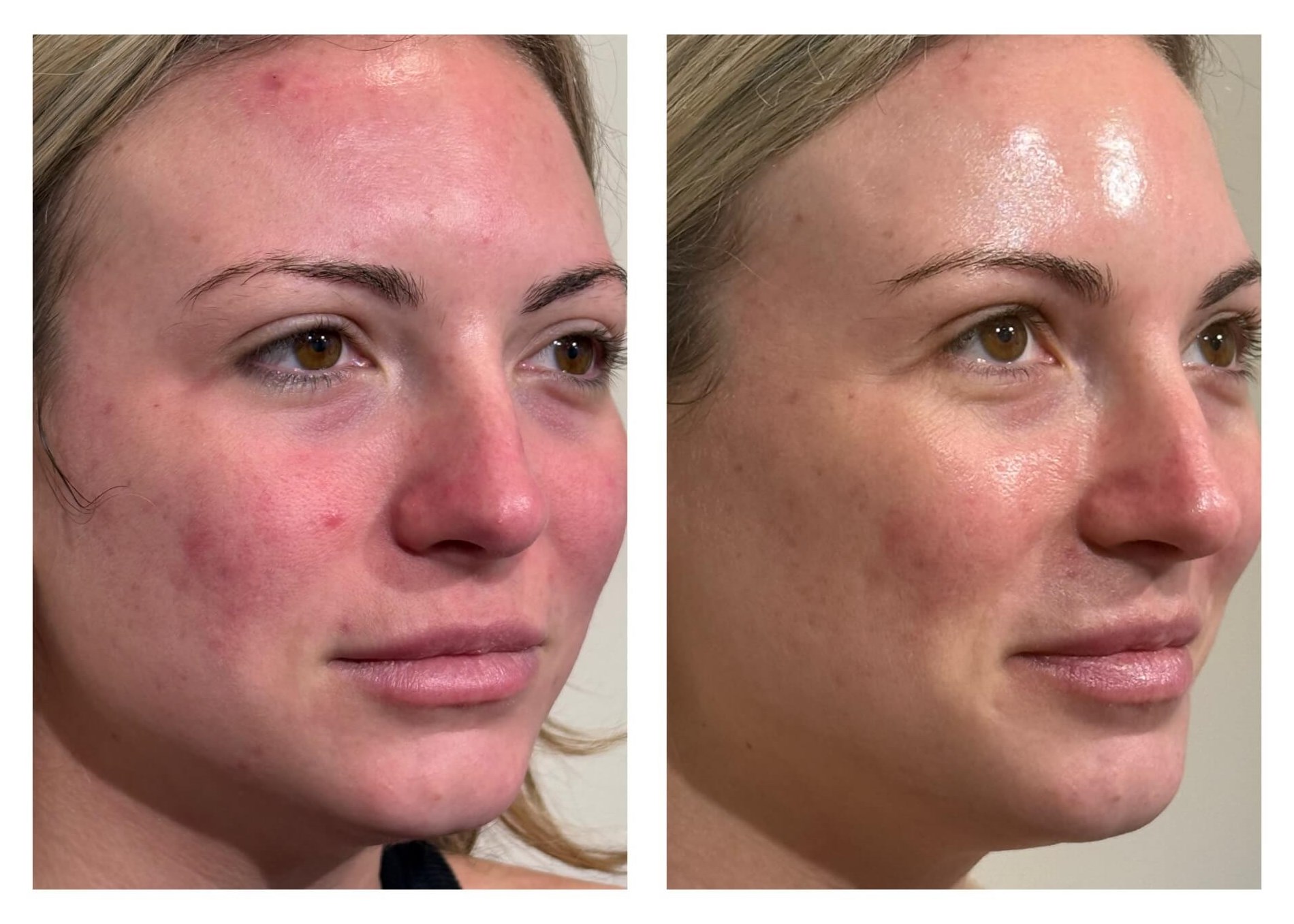 Neo Elite Laser treatment for